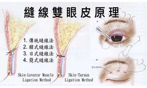 A01. 釘書機 - 單眼皮 < 單純 >  |服務項目|顏面整形|眼部手術|縫線雙眼皮