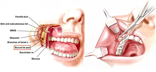 1. 單純口內取脂手術A  |案例分享|顏面整形