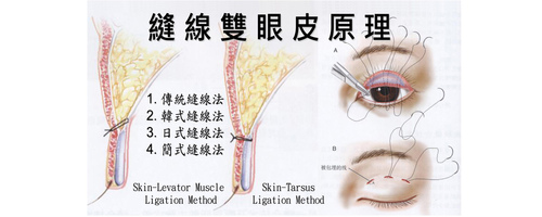 A02.釘書機 - 單眼皮 < 多摺 >A  |案例分享|顏面整形|眼部手術|釘書機雙眼皮