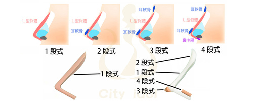 1(B).馬鞍鼻 < 拉長鼻尖 > { 併增高山根及加挺鼻尖 } [Ｌ型2段 ]x  |案例分享|顏面整形|鼻部手術|內開結構式隆鼻